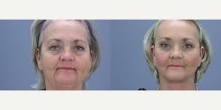 John A. Standefer Jr., MD, FACS, Board Certified Facial Plastic Surgeon