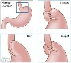 Types Of Fundoplycations Surgery Nursing Surgery Medical Studies