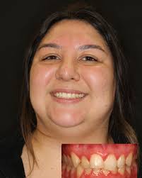 SMILES by Dr. AYZIN (@dentistryatitsfinest) · Instagram 照片和视频