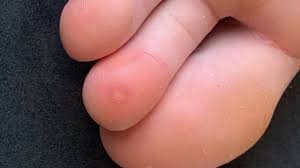 Pada kasus yang lebih parah, ruam itu sendiri dapat jadi tidak selalu hanya tangan, kaki, dan mulut. Virus Corona Jari Kaki Covid Kondisi Klinis Ruam Pada Sejumlah Pasien Yang Mungkin Adalah Gejala Baru Bbc News Indonesia