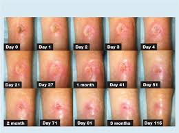 Maybe you would like to learn more about one of these? Healing Of An Arterial Leg Ulcer By Compression Bandaging A Case Report Journal Of Wound Care