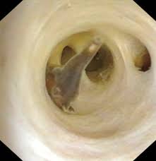 Vídeo mostra 5 vermes parasitas presos dentro do abdômen de um homem de 70  anos