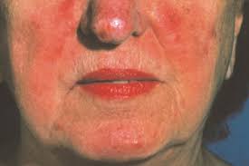 Résultat de recherche d'images pour "rosacea"