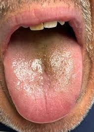 Image result for black hairy tongue symptoms