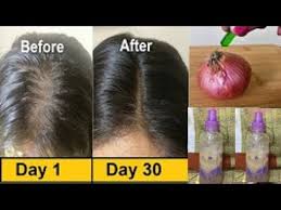 The role of nutrition and diet in treating hair loss represents a dynamic and growing area of inquiry. Hair Growth Spray Use Vitamin E Oil Mixed With Onion Juice For Long Hair Regrowth Lost Hair Youtube