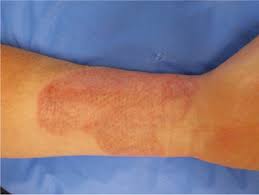 Sulfamylon liquid (5% soln) for wetting heavily contaminated meshed skin grafts or excised but not. Scarring After Burn Injury Intechopen