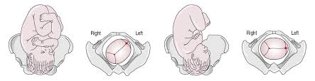 Image result for Manual Rotation in Occipitoposterior Presentation