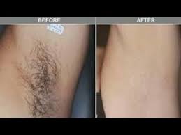 Youtube Laser Hair Removal At Home Hair Removal Hair Removal