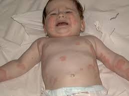 Image result for Urticaria pigmentosa children