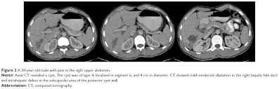 Gharbi classification of hydatid cyst. Value Of Cyst Localization To Predict Cystobiliary Communication In Pa Tcrm