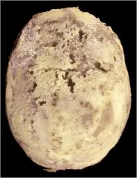 Transmission, signs, symptoms in men and women, disease stages, diagnosis. Porous And Hyperostotic Calvarium In A Case Of Tertiary Syphilis Download Scientific Diagram