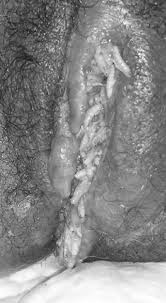 Severe Vaginal Myiasis: Successful Management With Ivermectin -  International Journal of Infectious Diseases