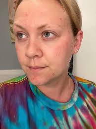 Not sure if it's been said before but the skin virus drops work wonders