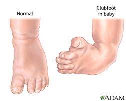 Clubfoot, also known as talipes equinovarus (tev), is a common foot abnormality, in which the foot points downward and inward. Clubfoot Multimedia Encyclopedia Health Information St Luke S Hospital