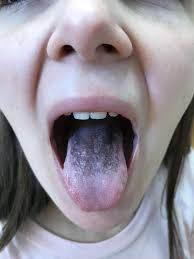 Image result for black tongue symptoms