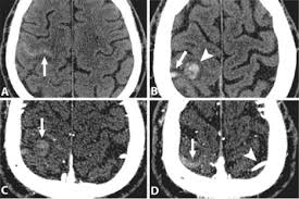 Cvst is a rare form of stroke. Isolated Cortical Vein Thrombosis Case Series In Journal Of Neurosurgery Volume 123 Issue 2 2015