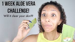 3 Aloe Vera Face Masks for Acne FREE Skin + Radiant Healthy Glow & Even  Skin Tone
