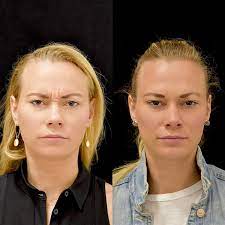 Both last for approximately four months, with some variation between patients. I Tried Injectables For The First Time And I Have Thoughts Glamour