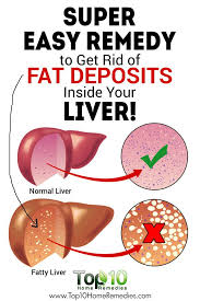 Home Remedies For Fatty Liver Disease Top 10 Home Remedies Liver Health Healthy Liver Fatty Liver