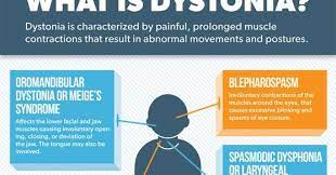Dystonia And Parkinson S Disease Parkinsons Disease Parkinsons Disease