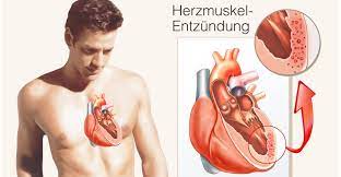 Bei einer herzmuskelentzündung fehlen häufig typische symptome, was die diagnose erschwert. Mooci Herzmuskelentzundung So Wirst Du Sie Los
