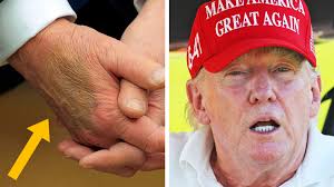 Their explanation for Trump's bruises MAKES NO SENSE