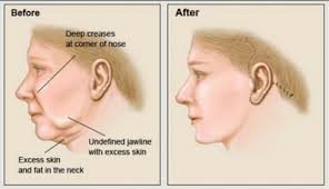 There are other methods of reducing melanin uniformly on the body, including injections and bleaching pills for black women. Cosmetic Surgery In India Plastic Surgery