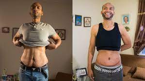Skin remover jetzt günstig bestellen. After Huge Weight Loss Sagging Skin Remains