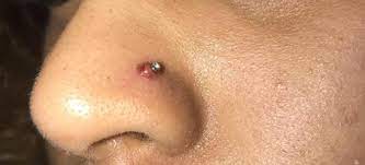 Nose Piercing Bumps What Are They And How To Get Rid Of Them Pierced