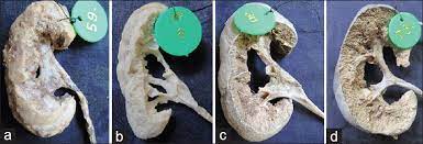 Suppose i have an array of 10 observations (belong to class a or b), 5 columns and 2 subclasses (c, d) as an additional dimension and i would like to make a binary classification (to a or b class) in. Gross Morphological Study Of The Renal Pelvicalyceal Patterns In Human Cadaveric Kidneys Anjana T Muthian E Thiagarajan S Shanmugam S Indian J Urol