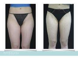 10 Vaser Lipo To The Thighs Ideas Vaser Lipo Vaser Outer Thighs