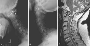 Image result for XRay Changes in Rheumatic Conditions