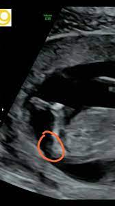 Geschlecht Baby Erkennen Ultraschall