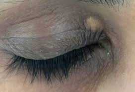 Image result for xanthelasma of eyelid