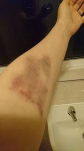 I had blood taken nearly 3 weeks ago now in my hand. Bruising After Blood Tests Babycentre