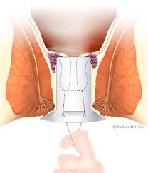 Internal hemorrhoids usually present with painless, bright red rectal bleeding during or following a bowel movement. How To Get Rid Of Hemorrhoids Types Treatment Symptoms Causes