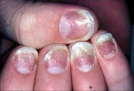 Faz com que a unha cresça de forma anormal, engrosse, escame, mude de cor e até se deforme. Psoriase Brasil Depressoes Hemorragias Debaixo Da Unha Facebook