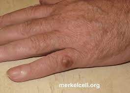 Watch for new spots or areas that are changing. Symptoms Of Merkel Cell Carcinoma