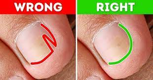 How to cut toenails to prevent ingrown. 9 Effective Ways To Fix Ingrown Toenails