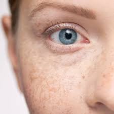 Image result for Freckled skin