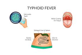 Typhoid fever is an acute generalized infection of the mononuclear phagocyte system, intestinal lymphoid tissue, and gallbladder caused by salmonella enterica serovar typhi. Typhoid Fever Symptom Causes Treatment Prevention
