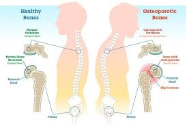 Osteoarthritis of the spine is a breakdown of the cartilage of the joints and discs in the neck and lower back. Osteoporosis And Fractures Of The Spine A Silent But Dangerous Disease