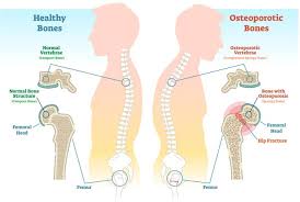 Osteoporosis And Fractures Of The Spine A Silent But Dangerous Disease