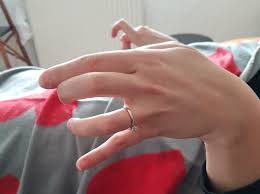 Dystonie et mouvements involontaires dans les SED - SED in FRANCE