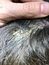 Itchy Scalp Clinic Dry Scalp Flaky Scalp