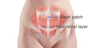 Umbilical Hernia Repair Mesh Umbilical Hernia Repair Hernia Repair Umbilical Hernia