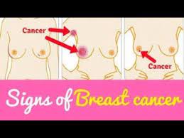 Breast cancer symptoms in hindi, istan ki iss bimari ke lakshan. 11 Home Remedies For Breast Cancer Women Health Tips Urdu Hindi Youtube