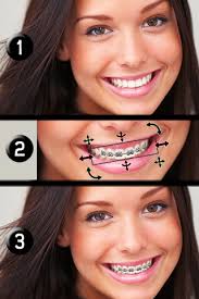 However, dentures do change the shape of your face, and create a healthier and more youthful appearance. Black Frog Industries Llc