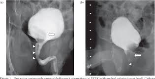 Image result for Voiding Cystourethrogram