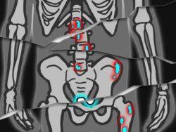 If you knee hurts you very much, take some cloth, wet it in cold water and put it on the bruise. Bone Metastasis Zero The End Of Prostate Cancer